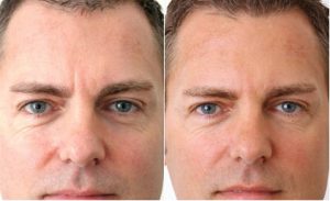 inyecciones de un neuromoduladór