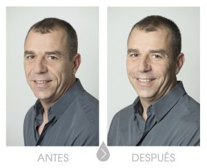 Ácido hialurónico, rellenos