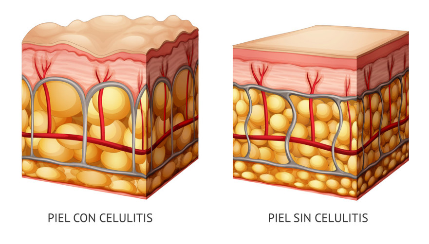 Celulitis Con Carboxiterapia